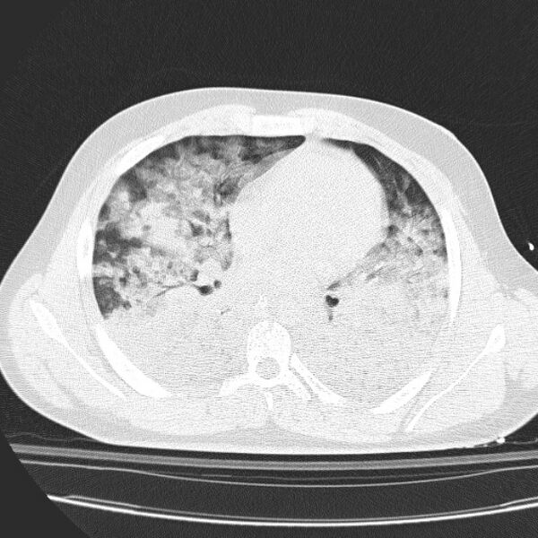 File:Acute aspiration pneumonitis (Radiopaedia 33605-34703 Axial lung window 54).jpg