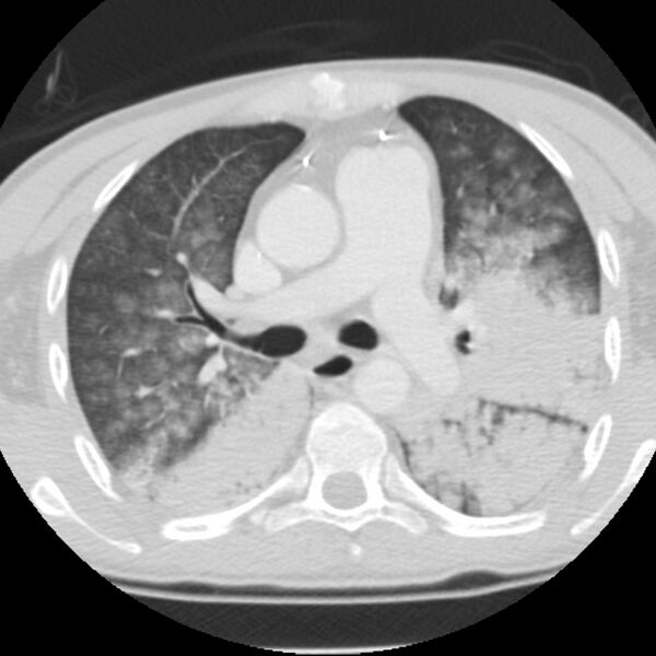 File:Acute diffuse alveolar hemorrhage (Radiopaedia 41323-44158 Axial lung window 23).jpg