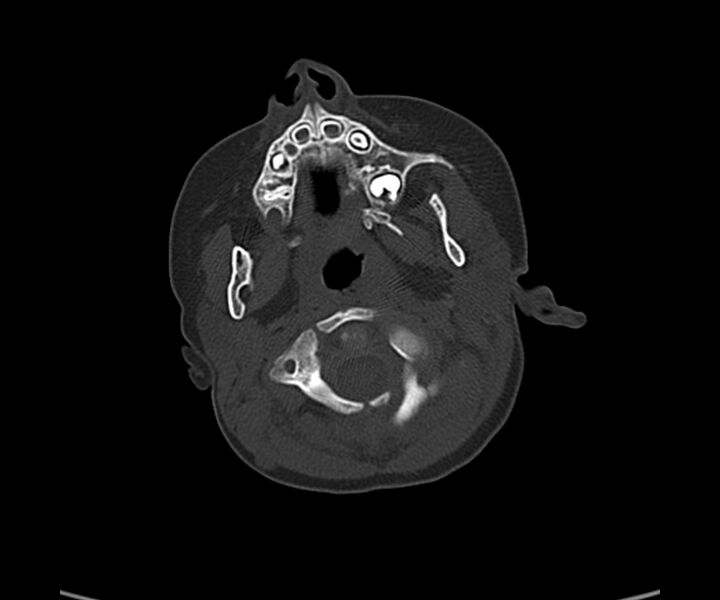 File:Acute hemorrhagic contusion (Radiopaedia 63660-72336 Axial bone window 7).jpg