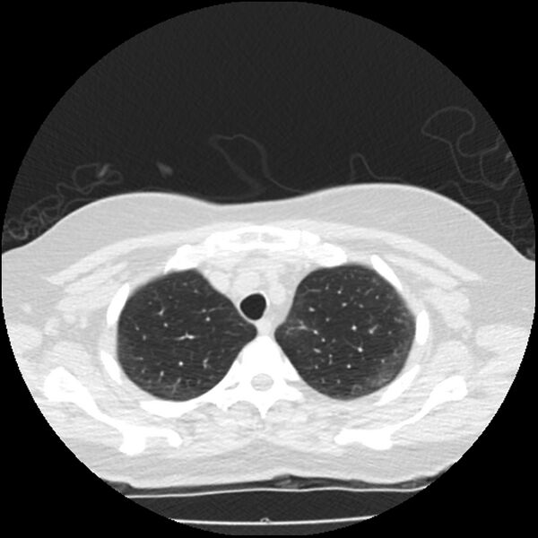 File:Acute interstitial pneumonitis (Radiopaedia 45404-49444 Axial lung window 19).jpg