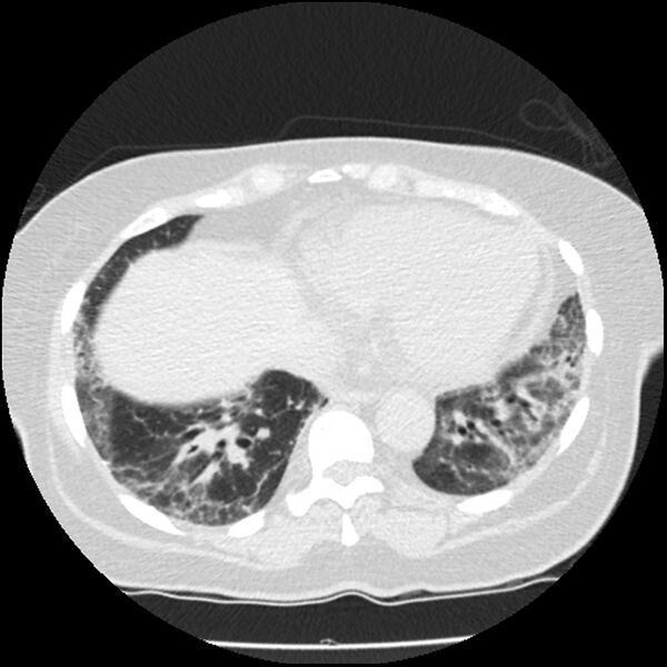 File:Acute interstitial pneumonitis (Radiopaedia 45404-49444 Axial lung window 75).jpg