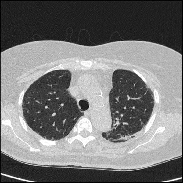 File:Acute interstitial pneumonitis (Radiopaedia 45404-49453 Axial lung window 26).jpg