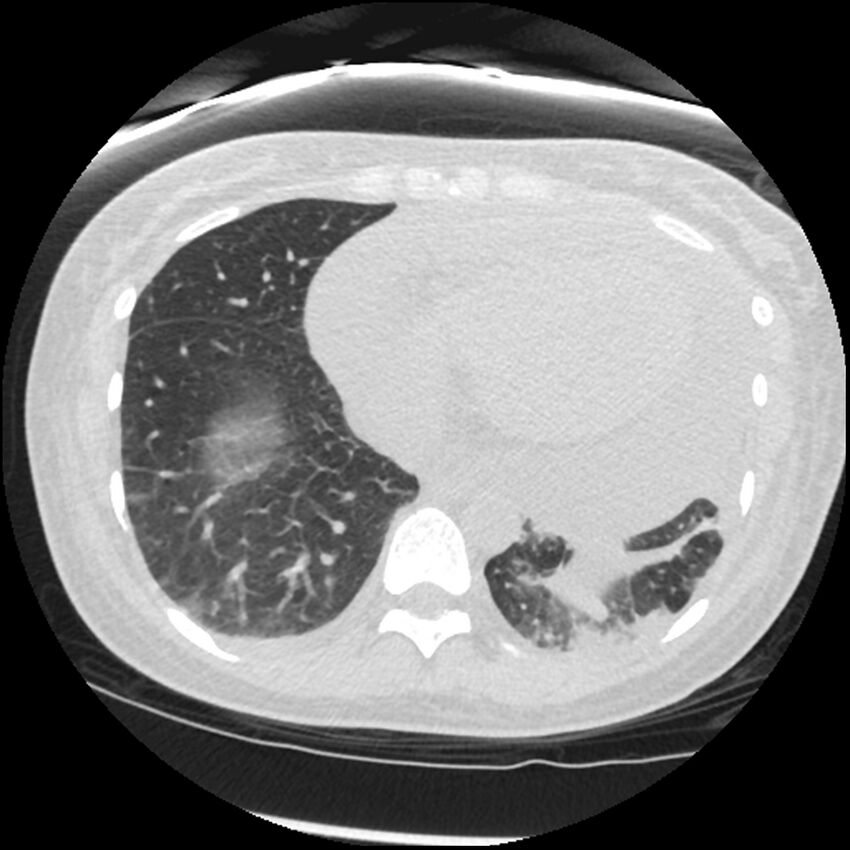 Acute lupus nephritis (Radiopaedia 45832-50107 Axial lung window 71).jpg
