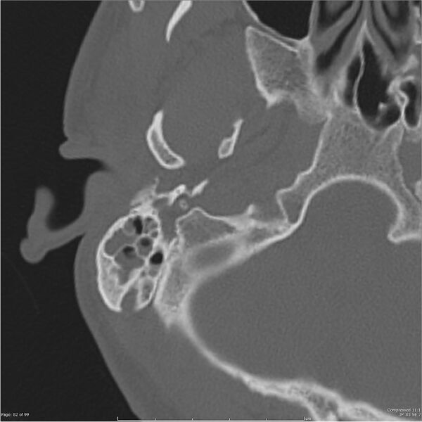 File:Acute otomastoiditis (Radiopaedia 28276-28512 Axial PTB bone window reformat 62).jpg