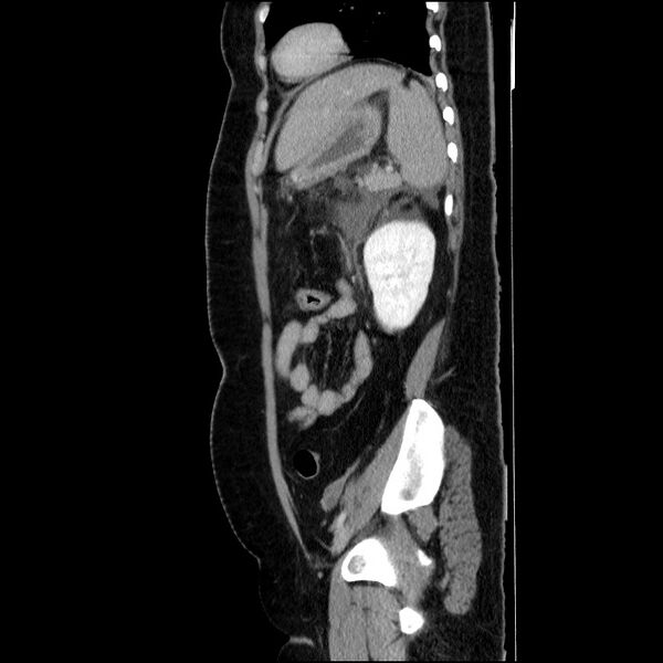 File:Acute pancreatitis (Radiopaedia 69236-79012 Sagittal C+ portal venous phase 34).jpg