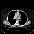 Acute pancreatitis - Balthazar C (Radiopaedia 26569-26714 Axial C+ portal venous phase 4).jpg