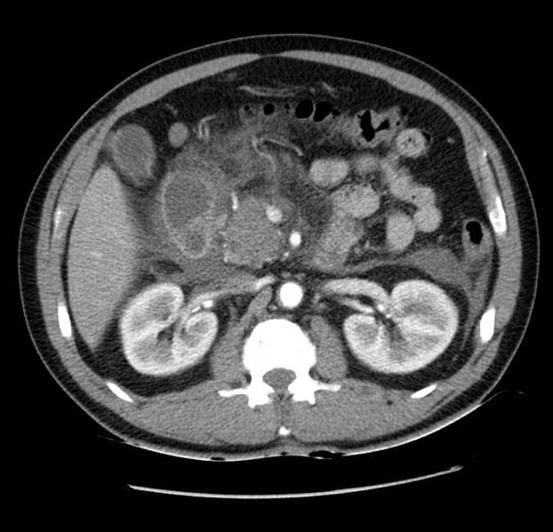 File:Acute pancreatitis - Balthazar E (Radiopaedia 23080-23110 Axial C+ arterial phase 27).jpg