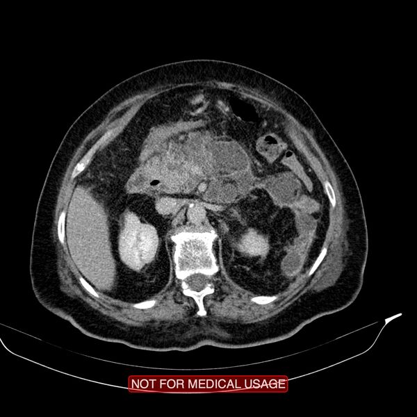 File:Acute pancreatitis with infected necrosis (Radiopaedia 26454-26585 Axial C+ delayed 13).jpg