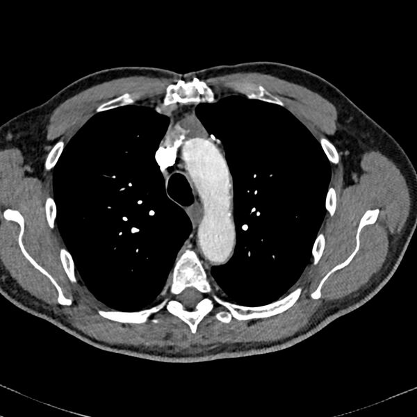 File:Acute pulmonary embolism (Radiopaedia 81677-95570 Axial C+ CTPA 9).jpg