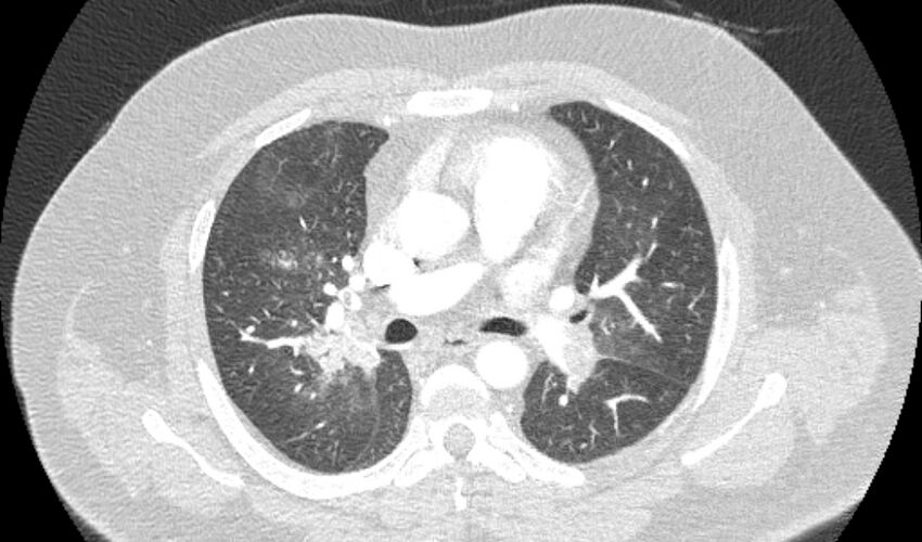 Acute pulmonary embolism with pulmonary infarcts (Radiopaedia 77688-89908 Axial lung window 49).jpg