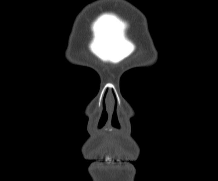 File:Acute sinusitis (Radiopaedia 22419-22455 Coronal bone window 1).jpg