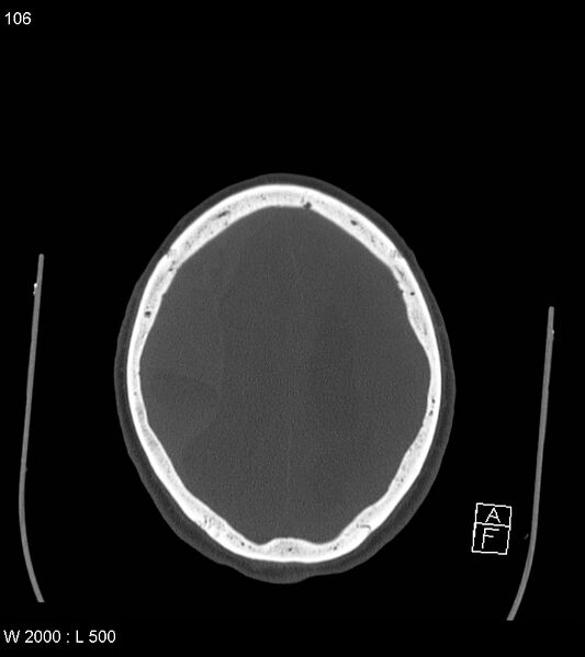 File:Acute subdural hematoma with myelofibrosis (Radiopaedia 52582-58494 Axial bone window 53).jpg