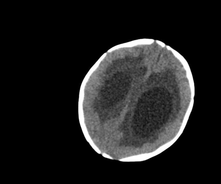 File:Acute ventriculitis (Radiopaedia 57502-64459 Axial non-contrast 15).jpg
