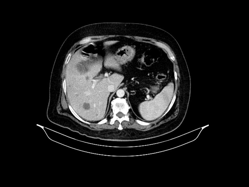 File:Adenocarcinoma of pancreas with hepatic metastasis (Radiopaedia 64332-73122 Axial C+ portal venous phase 27).jpg