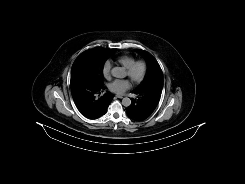 File:Adenocarcinoma of pancreas with hepatic metastasis (Radiopaedia 64332-73122 Axial non-contrast 7).jpg