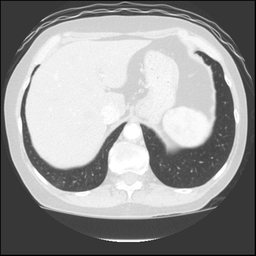 Adenocarcinoma of the lung (Radiopaedia 41015-43755 Axial lung window 110).jpg