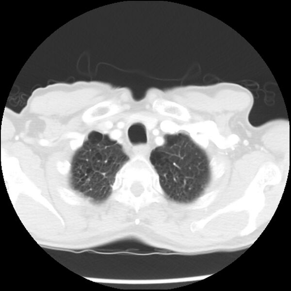 File:Adenocarcinoma of the lung - micropapillary predominant (Radiopaedia 42446-45563 Axial lung window 8).jpg