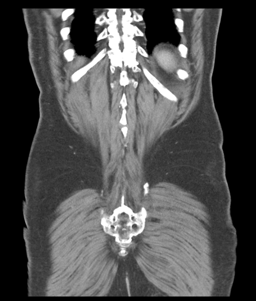 File:Adenocarcioma of rectum- T1 lesion (Radiopaedia 36921-38547 Coronal C+ portal venous phase 55).png