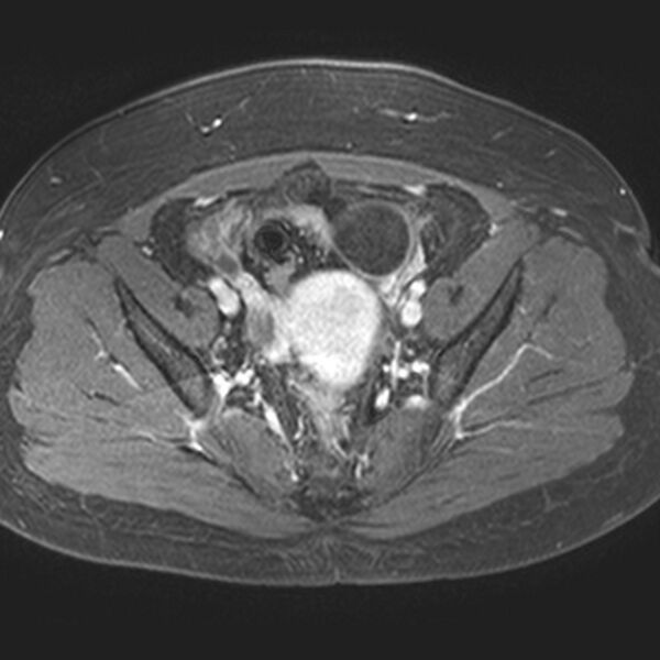 File:Adenomyoma of the uterus (Radiopaedia 9871-10439 Axial T1 C+ fat sat 16).jpg