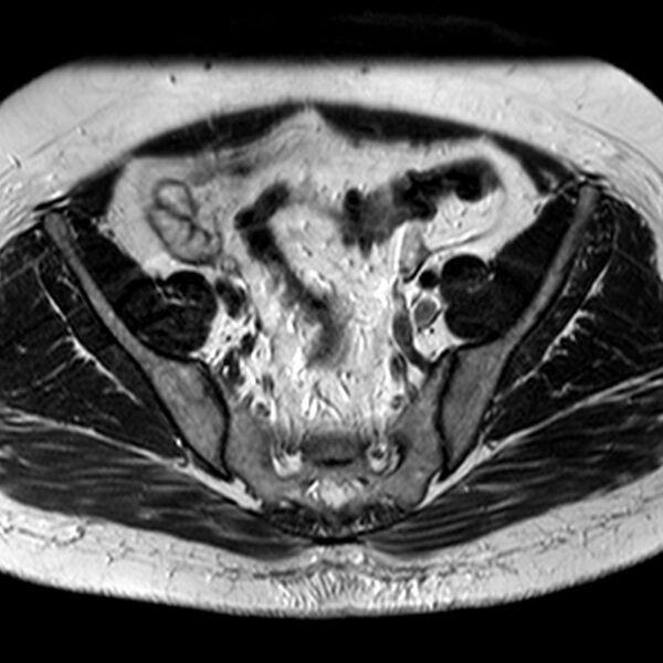 File:Adenomyoma of the uterus (Radiopaedia 9871-10439 Axial T2 23).jpg