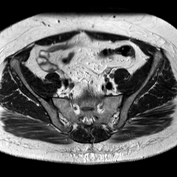 File:Adenomyoma of the uterus (Radiopaedia 9871-10439 Axial T2 26).jpg