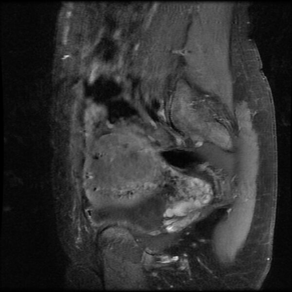 File:Adenomyosis on MRI (Radiopaedia 29328-29780 Sagittal T1 C+ fat sat 14).jpg