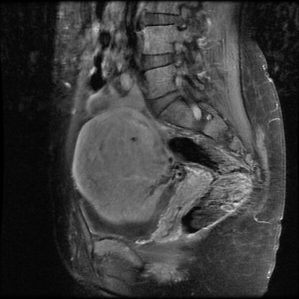 File:Adenomyosis on MRI (Radiopaedia 29328-29780 Sagittal T1 C+ fat sat 6).jpg