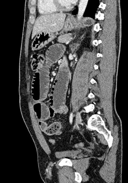 File:Adhesional small bowel obstruction (Radiopaedia 58900-66131 Sagittal C+ portal venous phase 148).jpg
