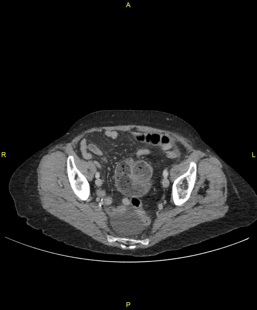 Adhesional small bowel obstruction (Radiopaedia 85402-101024 Axial C+ portal venous phase 240).jpg