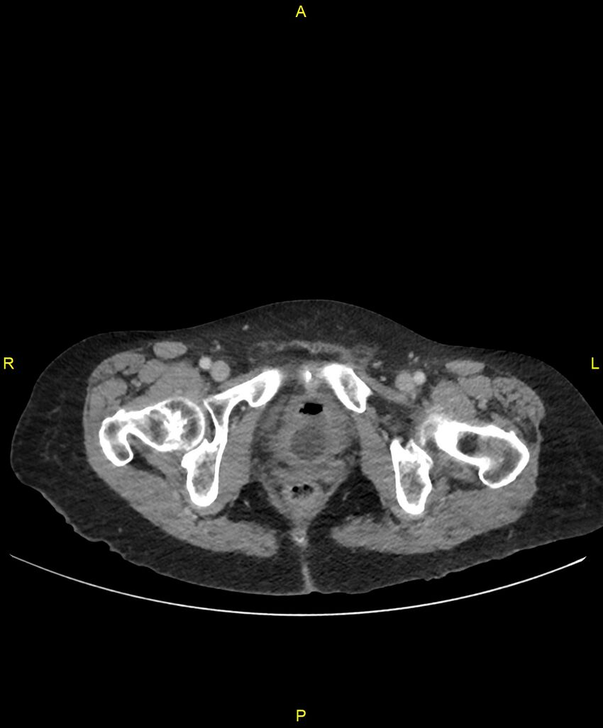 Adhesional small bowel obstruction (Radiopaedia 85402-101024 Axial C+ portal venous phase 284).jpg