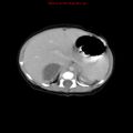 Adrenal hemorrhage (Radiopaedia 9390-10077 Axial C+ portal venous phase 5).jpg