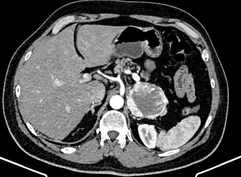 File:Adrenal metastases (Radiopaedia 73082-83791 Axial C+ arterial phase 44).jpg