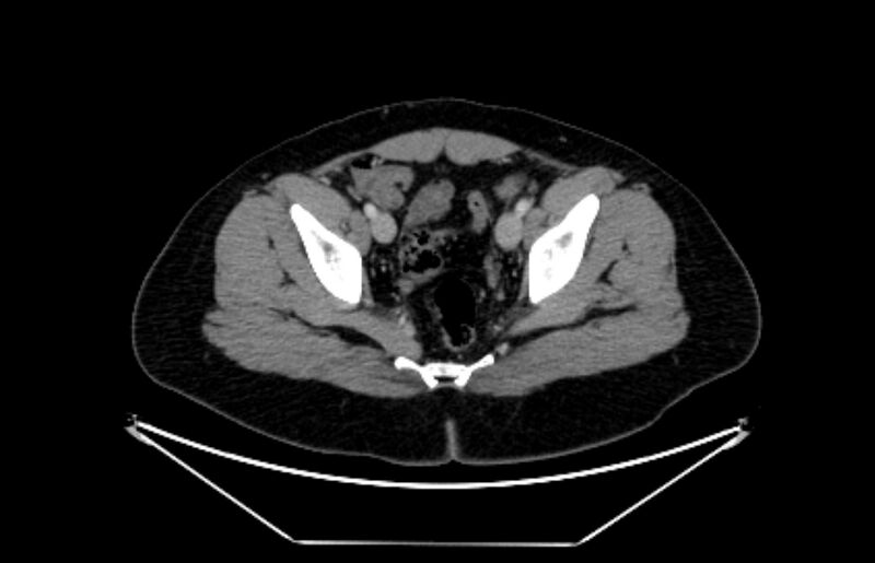 File:Adrenocortical carcinoma (Radiopaedia 80134-93438 Axial C+ portal venous phase 116).jpg
