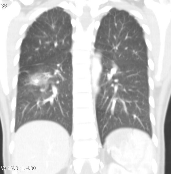 File:Air crescent sign (aspergilloma) (Radiopaedia 14380-14306 Coronal lung window 3).jpg