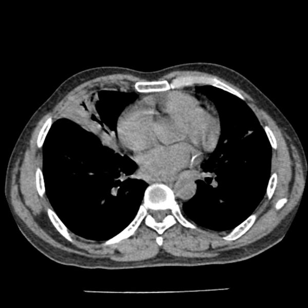 File:Airway foreign body in adult (Radiopaedia 85907-101779 Axial liver window 112).jpg