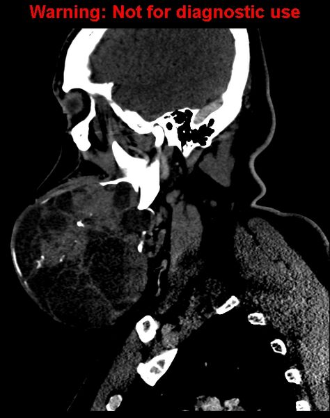 File:Ameloblastoma (Radiopaedia 33126-34164 F 20).jpg