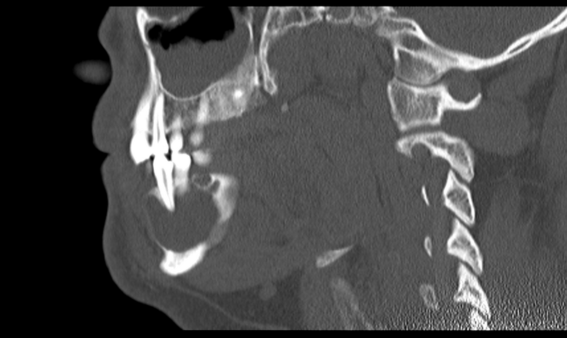 File:Ameloblastoma (Radiopaedia 33677-34806 Sagittal bone window 27).png