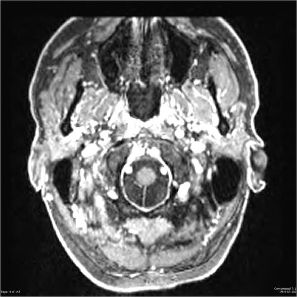 File:Anaplastic meningioma with recurrence (Radiopaedia 34452-35788 Axial T1 C+ 4).jpg