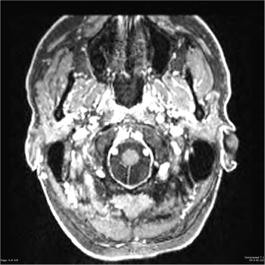 Anaplastic meningioma with recurrence (Radiopaedia 34452-35788 Axial T1 C+ 4).jpg