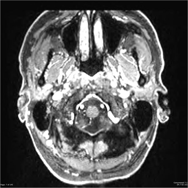 File:Anaplastic meningioma with recurrence (Radiopaedia 34452-35788 Axial T1 C+ 7).jpg