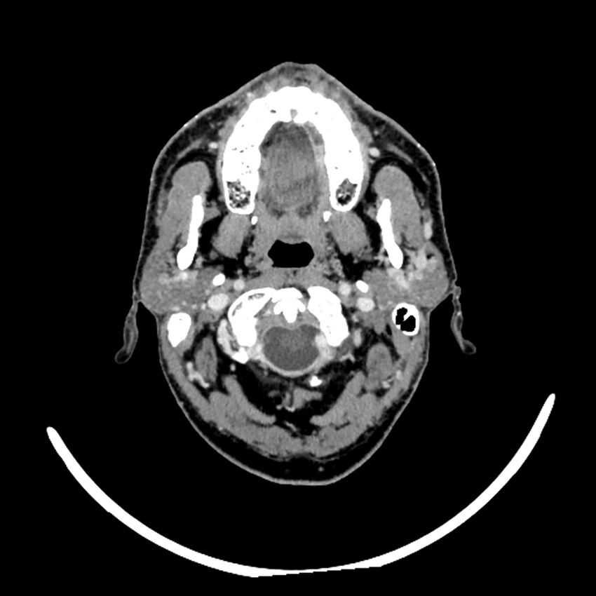 Anaplastic thyroid carcinoma (Radiopaedia 79087-92034 B 105).jpg
