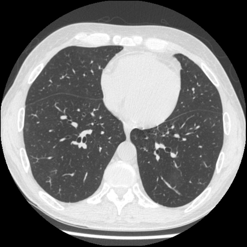 Angioinvasive aspergillosis (Radiopaedia 43957-47466 Axial lung window 45).jpg