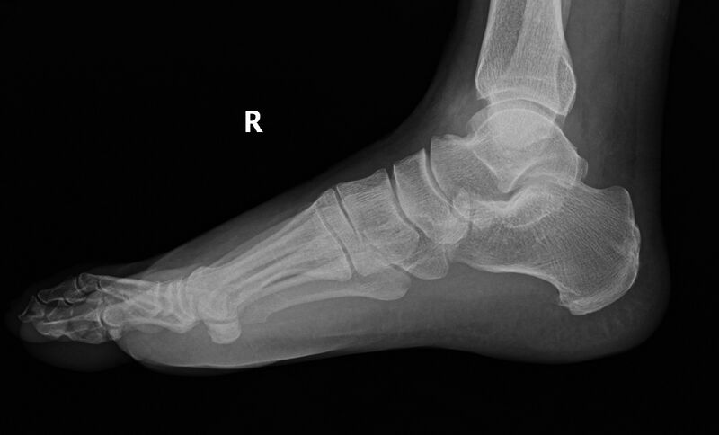 File:Ankle fracture - Weber A (Radiopaedia 9680-10306 Lateral 3).jpg