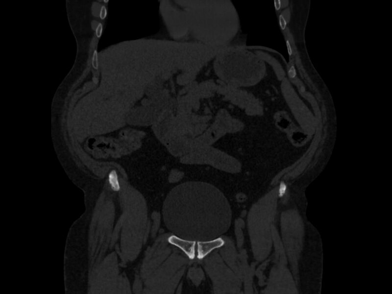 File:Ankylosing spondylitis (Radiopaedia 44609-48357 Coronal bone window 1).jpg