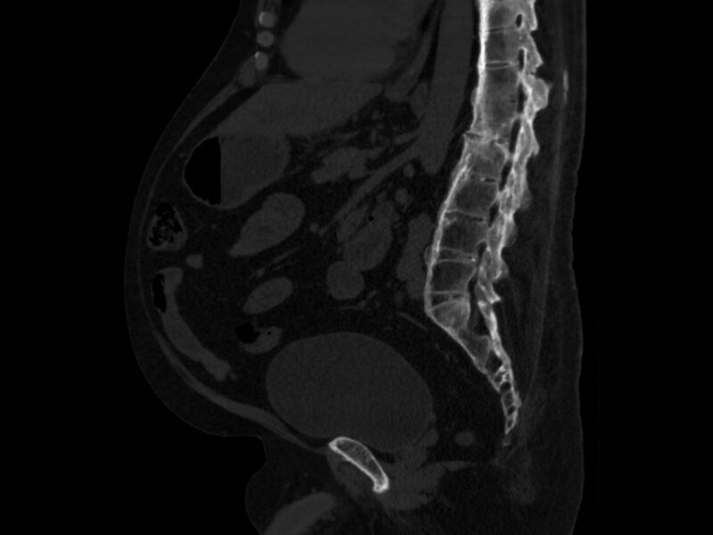 File:Ankylosing spondylitis (Radiopaedia 44609-48357 Sagittal bone window 59).jpg