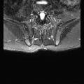 Ankylosing spondylitis with zygapophyseal arthritis (Radiopaedia 38433-40517 D 17).jpg