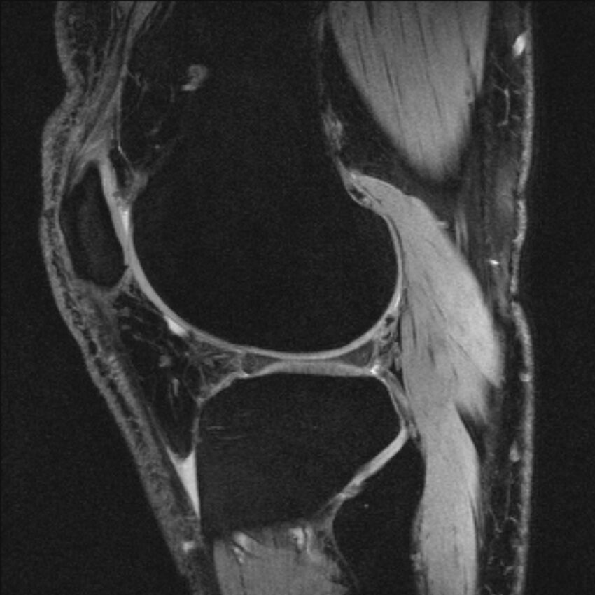 Anterior cruciate ligament mucoid degeneration (Radiopaedia 68400-77933 Sagittal 16).jpg