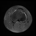 Anterior cruciate ligament tear, Wrisberg rip and bucket-handle tear of medial meniscus (Radiopaedia 75872-87266 Axial PD fat sat 8).jpg