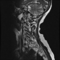 Anterior spinal artery syndrome (Radiopaedia 46335-50750 A 10).png