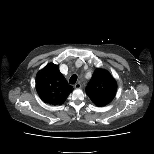File:Aortic arch graft infection (FDG PET-CT) (Radiopaedia 71975-82437 A 9).jpg